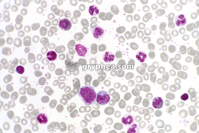 Leucémie aiguë x200 - gryphea.org